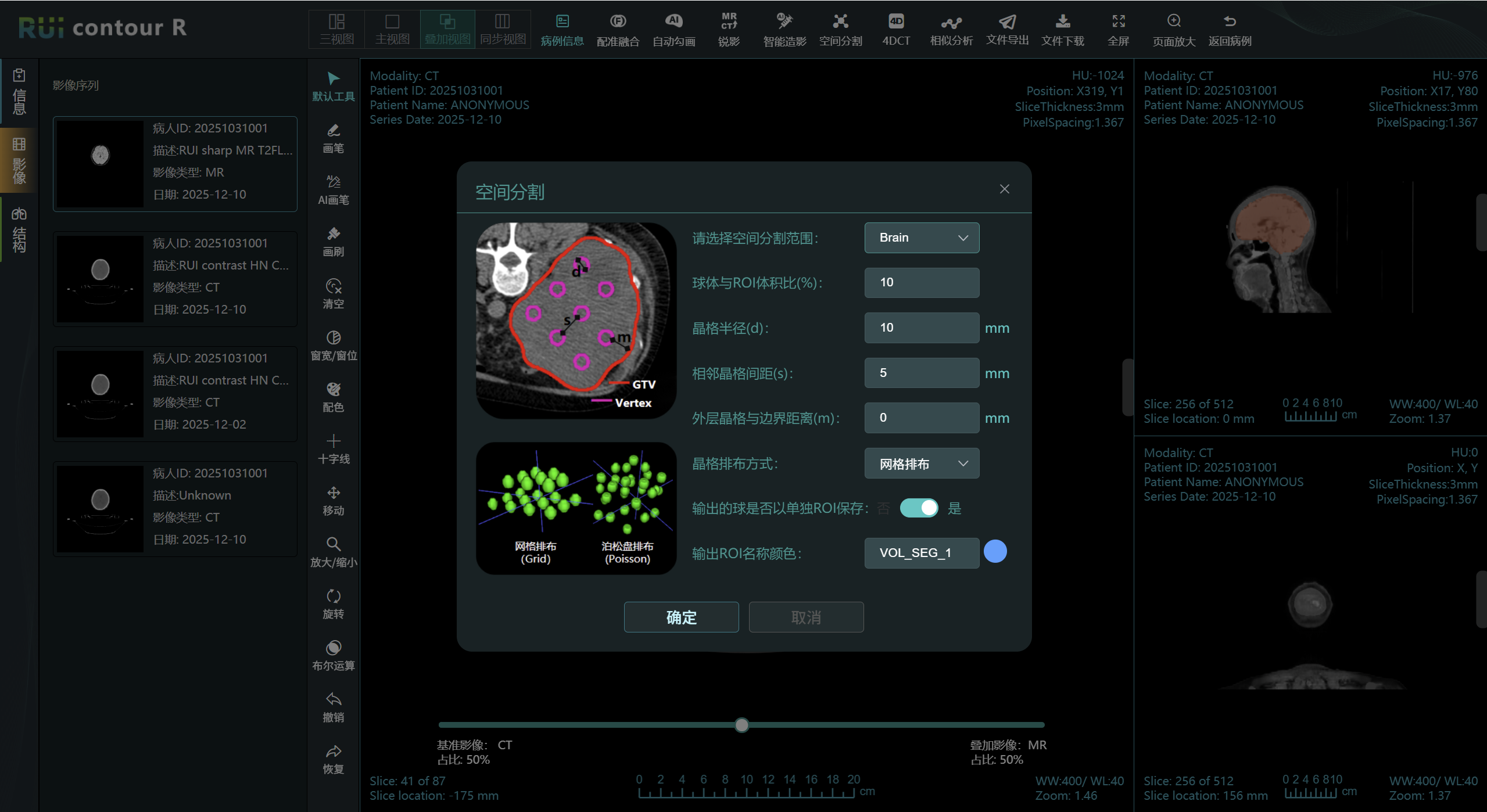 RUI Contour M 空间分割放疗功能界面