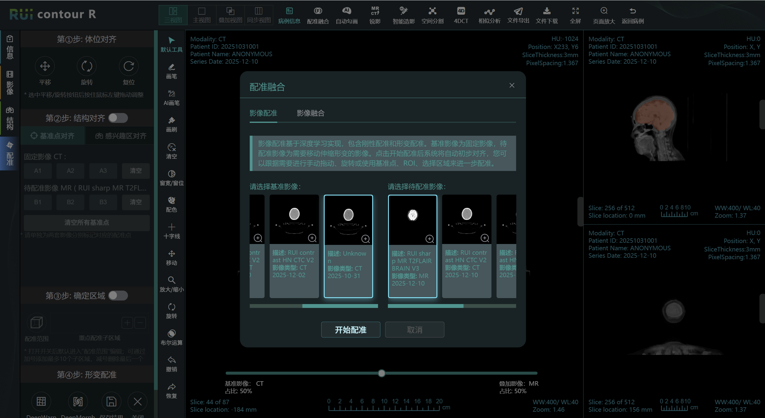 RUI Contour M 多模态图像配准及影像融合功能界面